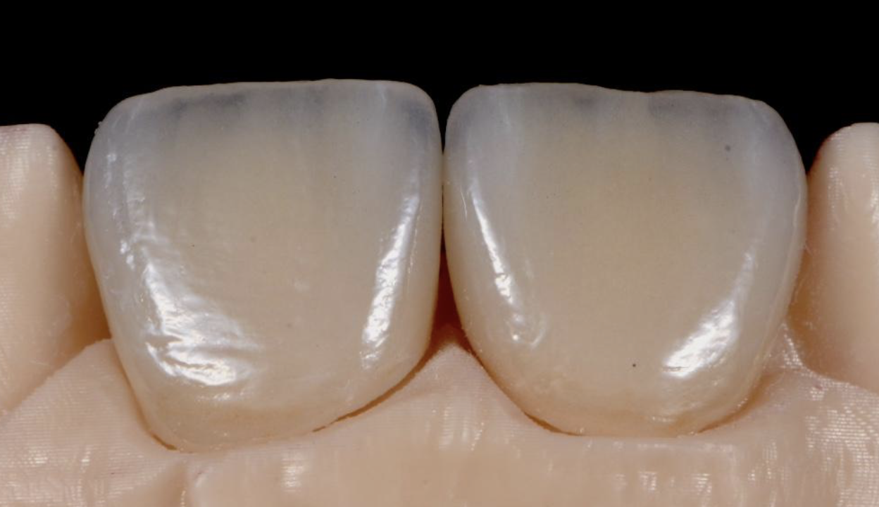 Facettes stratifiées sur disilicate