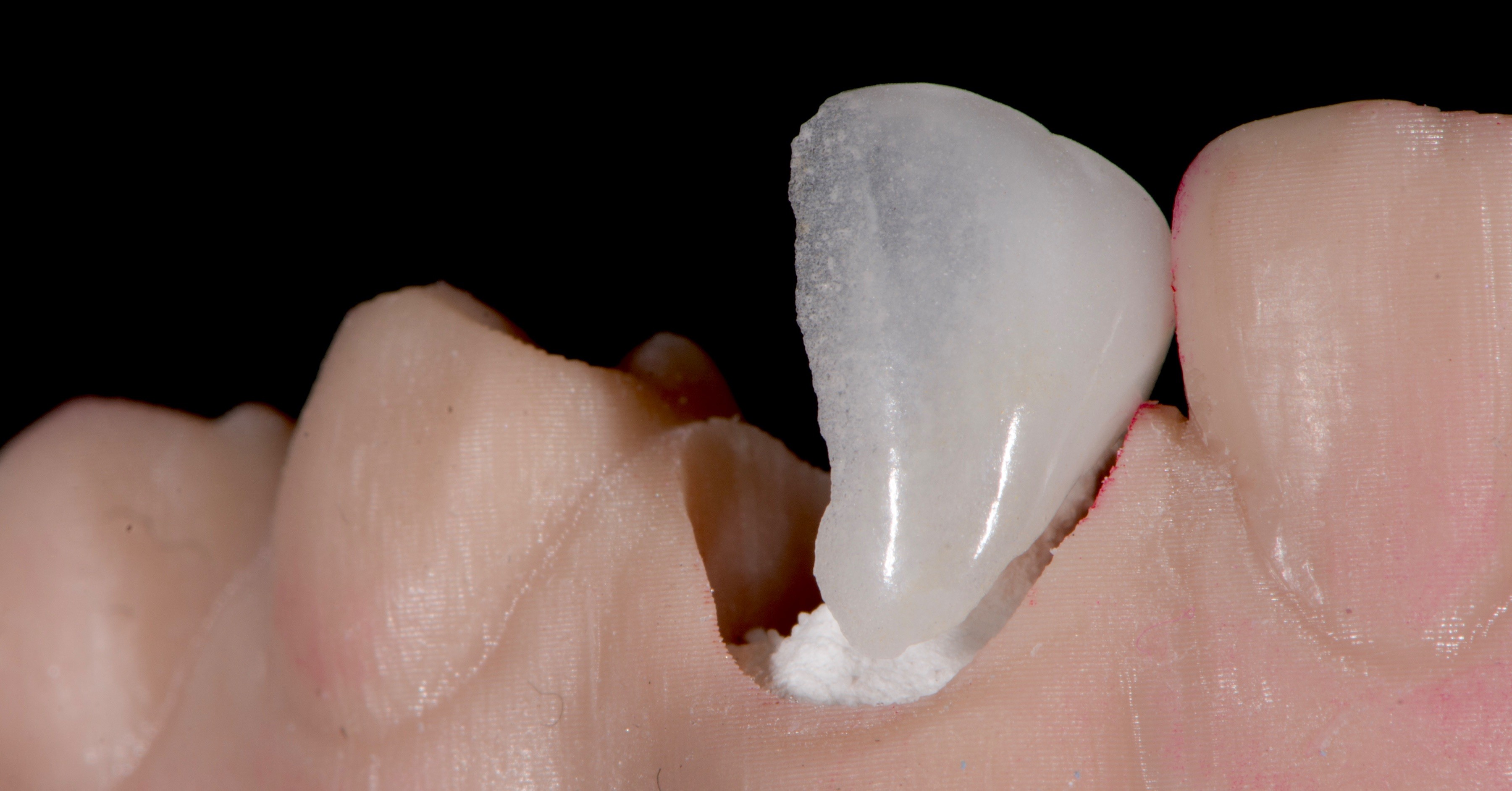 Facette feldspathique