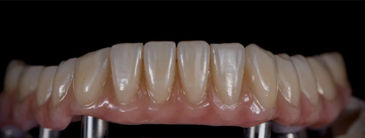 Bridge sur implants