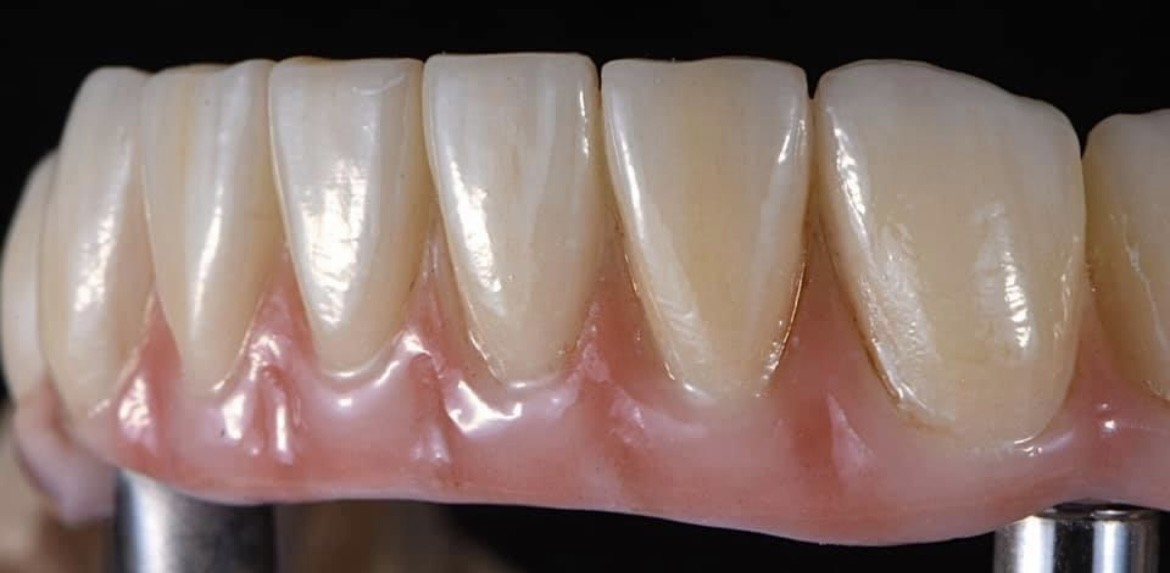 Bridge zr sur implants