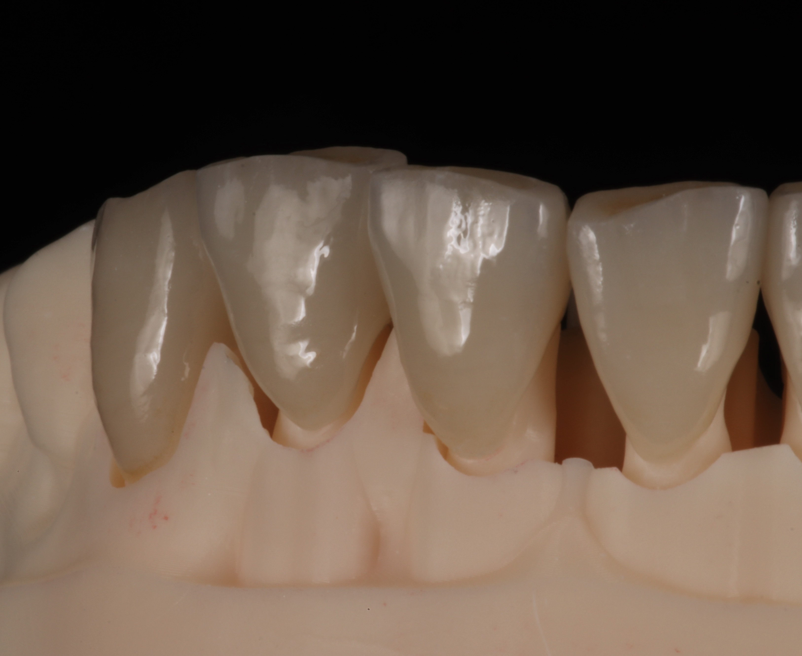 Full disilicate microstratifié